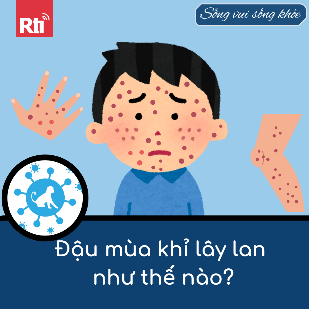 [Sống vui sống khỏe - Tập 96] Đậu mùa khỉ lây lan như thế nào?