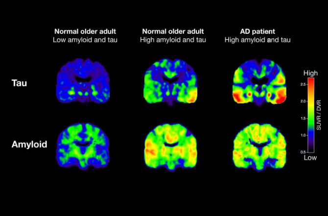 Nghiên cứu: Mất nhiễm sắc thể Y coi chừng bị bệnh Alzheimer