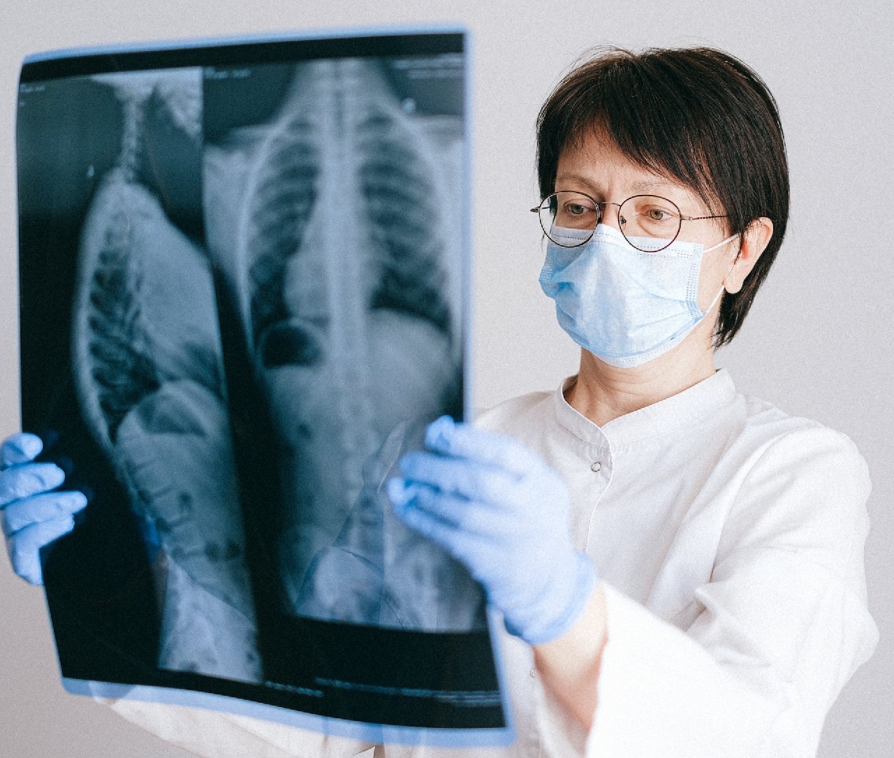 Có gần 1.000 trường hợp được xác nhận K phổi sau hơn 1 năm thực hiện chương trình sàng lọc, với 85% trường hợp ở giai đoạn đầu