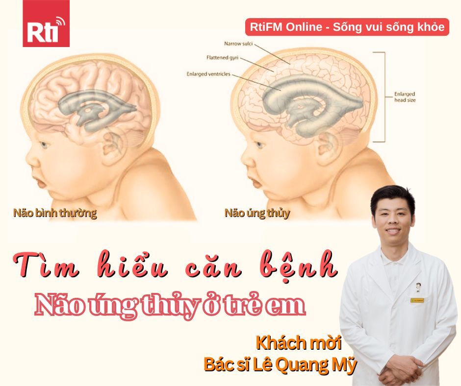 [Sống vui sống khỏe - Tập 99] Trò chuyện cùng bác sĩ Nhi khoa Lê Quang Mỹ về bệnh não úng thủy