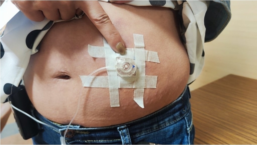 Móng đen, môi thâm – dấu hiệu cảnh báo bệnh tăng áp động mạch phổi nguy hiểm